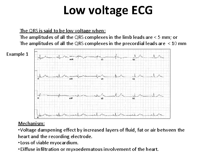 Low voltage ECG The QRS is said to be low voltage when: The amplitudes