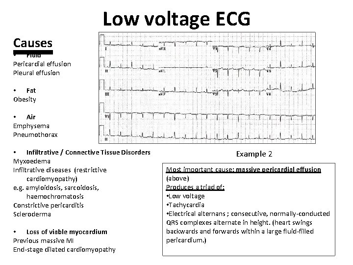Low voltage ECG Causes • Fluid Pericardial effusion Pleural effusion • Fat Obesity •