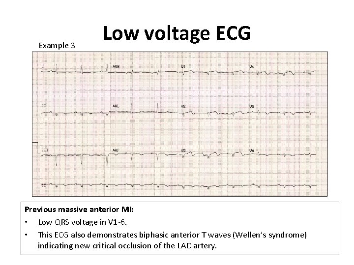 Example 3 Low voltage ECG Previous massive anterior MI: • Low QRS voltage in