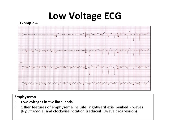 Example 4 Low Voltage ECG Emphysema • Low voltages in the limb leads •