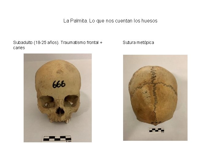 La Palmita. Lo que nos cuentan los huesos Subadulto (18 -25 años). Traumatismo frontal
