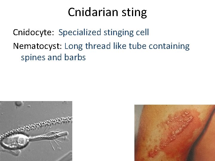 Cnidarian sting Cnidocyte: Specialized stinging cell Nematocyst: Long thread like tube containing spines and