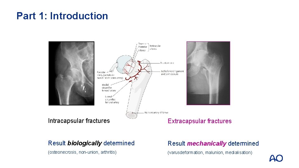 Part 1: Introduction Intracapsular fractures Extracapsular fractures Result biologically determined Result mechanically determined (osteonecrosis,