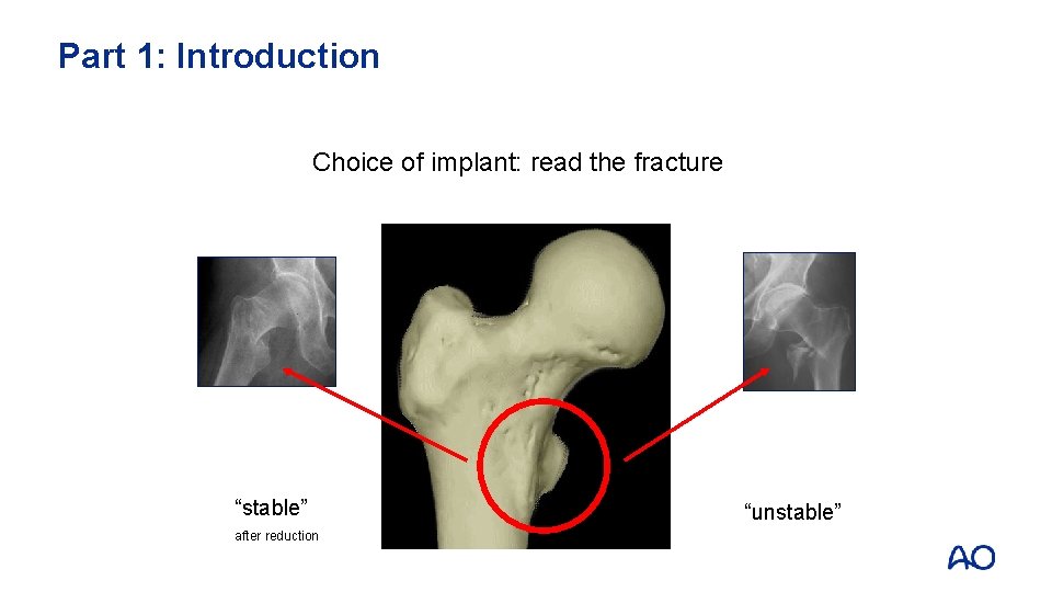 Part 1: Introduction Choice of implant: read the fracture “stable” after reduction “unstable” 