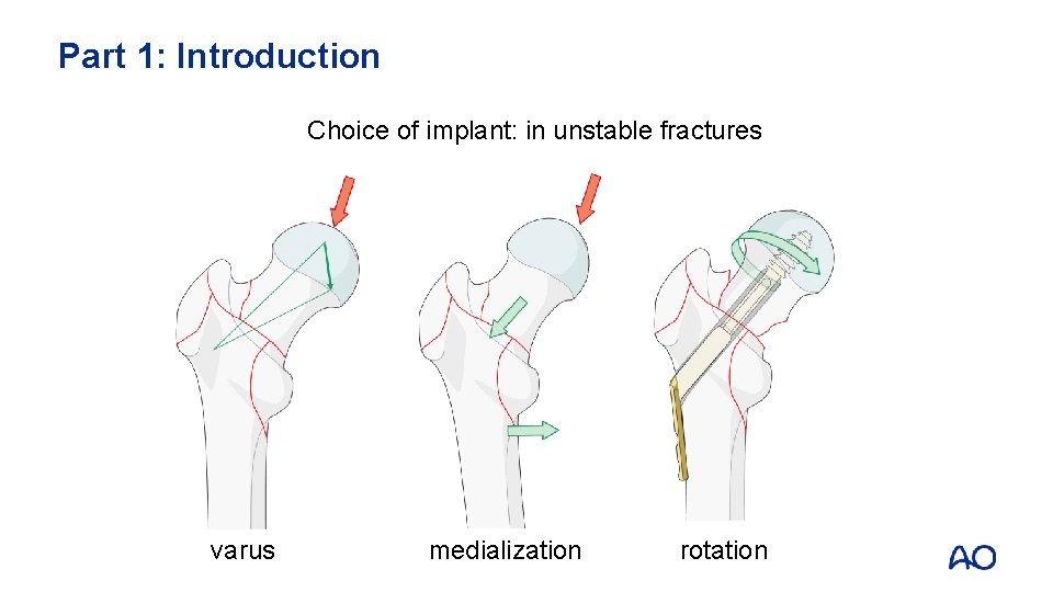 Part 1: Introduction Choice of implant: in unstable fractures varus medialization rotation 