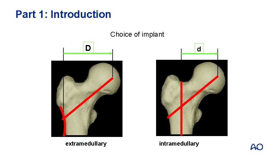 Part 1: Introduction Choice of implant D extramedullary d intramedullary 