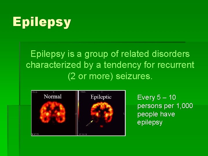 Epilepsy is a group of related disorders characterized by a tendency for recurrent (2