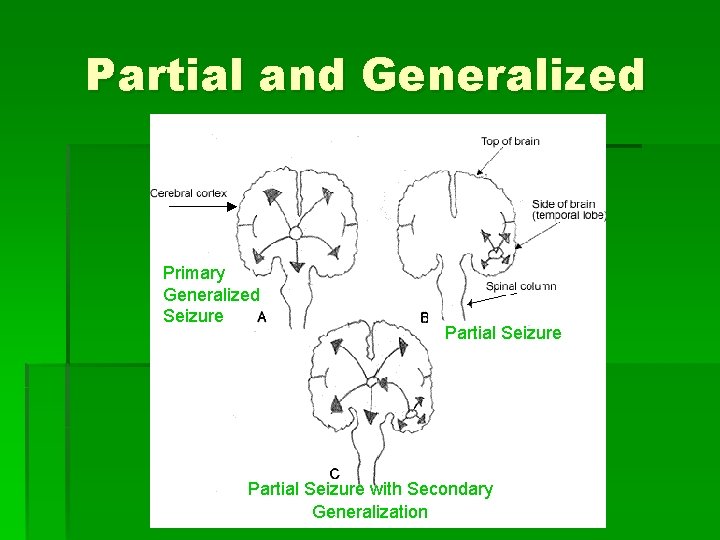 Partial and Generalized Primary Generalized Seizure Partial Seizure with Secondary Generalization 