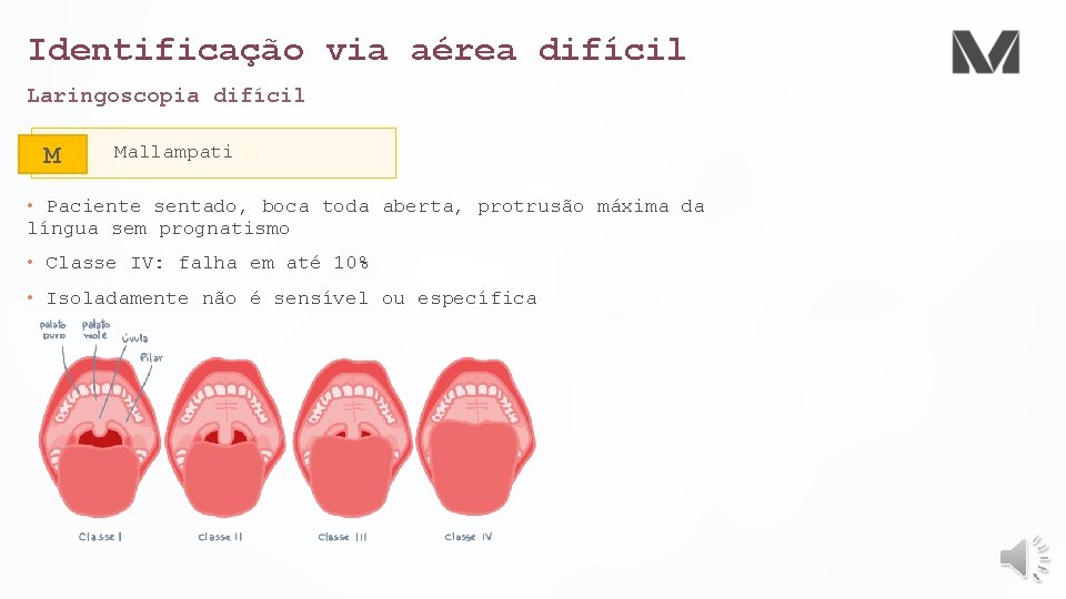 Identificação via aérea difícil Laringoscopia difícil M Mallampati • Paciente sentado, boca toda aberta,