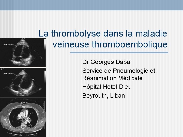 La thrombolyse dans la maladie veineuse thromboembolique Dr Georges Dabar Service de Pneumologie et