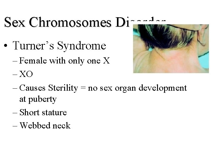 Sex Chromosomes Disorder • Turner’s Syndrome – Female with only one X – XO