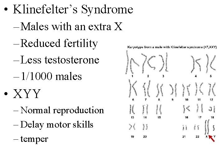  • Klinefelter’s Syndrome – Males with an extra X – Reduced fertility –