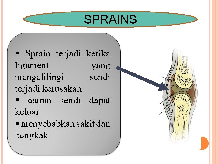 SPRAINS § Sprain terjadi ketika ligament yang mengelilingi sendi terjadi kerusakan § cairan sendi