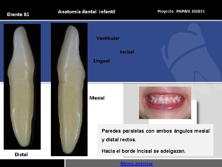 Diente 81 Anatomía dental infantil Proyecto PAPIME 202815 Vestibular incisal Lingual Mesial Paredes paralelas