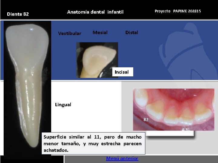 Diente 82 Proyecto PAPIME 202815 Anatomía dental infantil Vestibular Mesial Distal Incisal Lingual 82