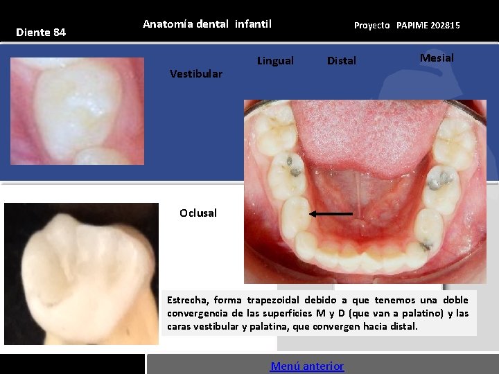 Diente 84 Anatomía dental infantil Vestibular Lingual Proyecto PAPIME 202815 Distal Mesial Oclusal Estrecha,