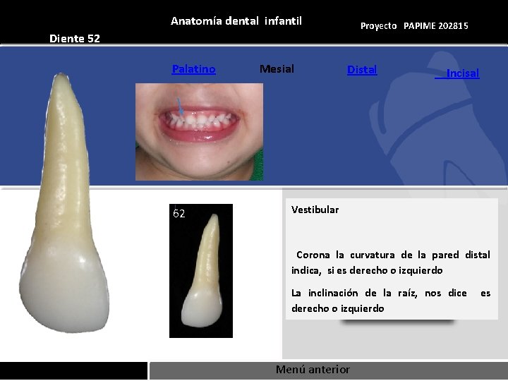 Anatomía dental infantil Proyecto PAPIME 202815 Diente 52 Palatino 62 Mesial Distal Incisal Vestibular