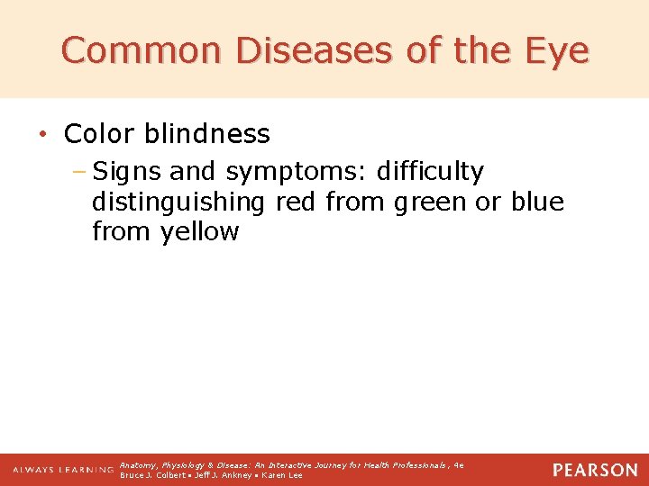 Common Diseases of the Eye • Color blindness – Signs and symptoms: difficulty distinguishing