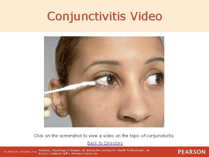 Conjunctivitis Video Click on the screenshot to view a video on the topic of