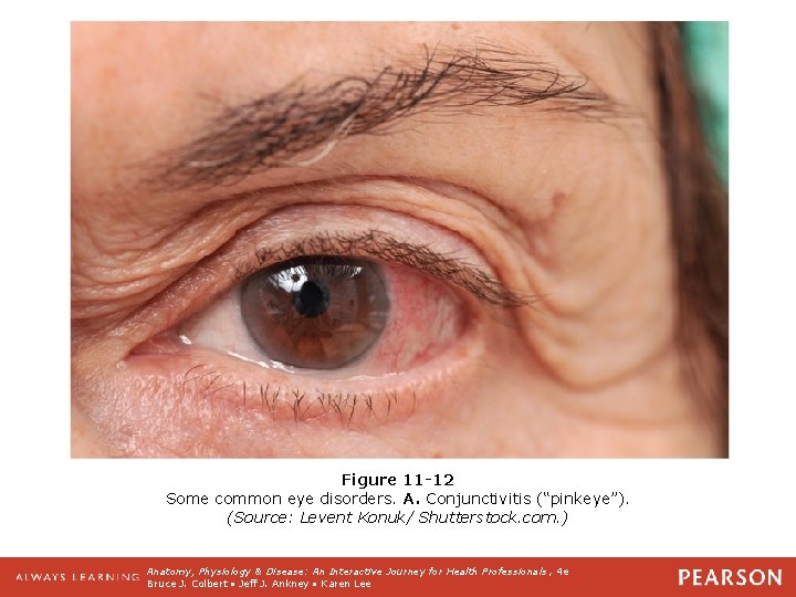 Figure 11 -12 Some common eye disorders. A. Conjunctivitis (“pinkeye”). (Source: Levent Konuk/ Shutterstock.