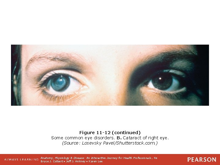 Figure 11 -12 (continued) Some common eye disorders. B. Cataract of right eye. (Source: