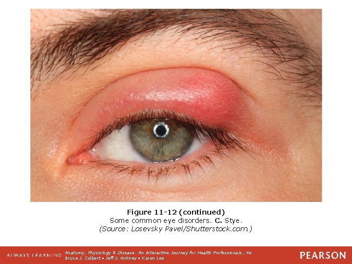 Figure 11 -12 (continued) Some common eye disorders. C. Stye. (Source: Losevsky Pavel/Shutterstock. com.