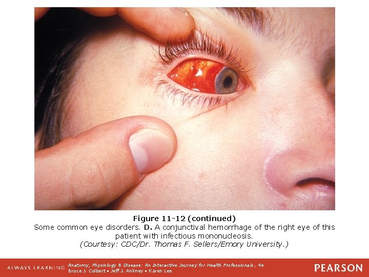 Figure 11 -12 (continued) Some common eye disorders. D. A conjunctival hemorrhage of the
