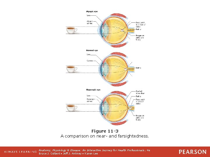 Figure 11 -3 A comparison on near- and farsightedness. Anatomy, Physiology & Disease: An
