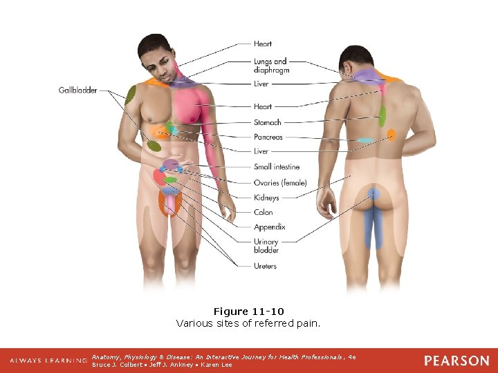 Figure 11 -10 Various sites of referred pain. Anatomy, Physiology & Disease: An Interactive