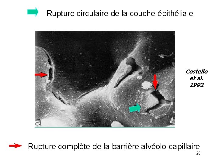 Rupture circulaire de la couche épithéliale Costello et al. 1992 Rupture complète de la