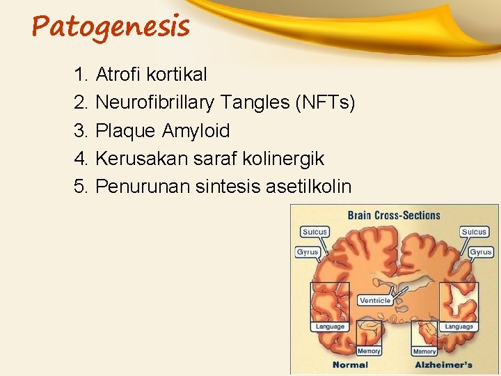 Patogenesis 1. Atrofi kortikal 2. Neurofibrillary Tangles (NFTs) 3. Plaque Amyloid 4. Kerusakan saraf