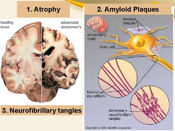 1. Atrophy 3. Neurofibrillary tangles 2. Amyloid Plaques 