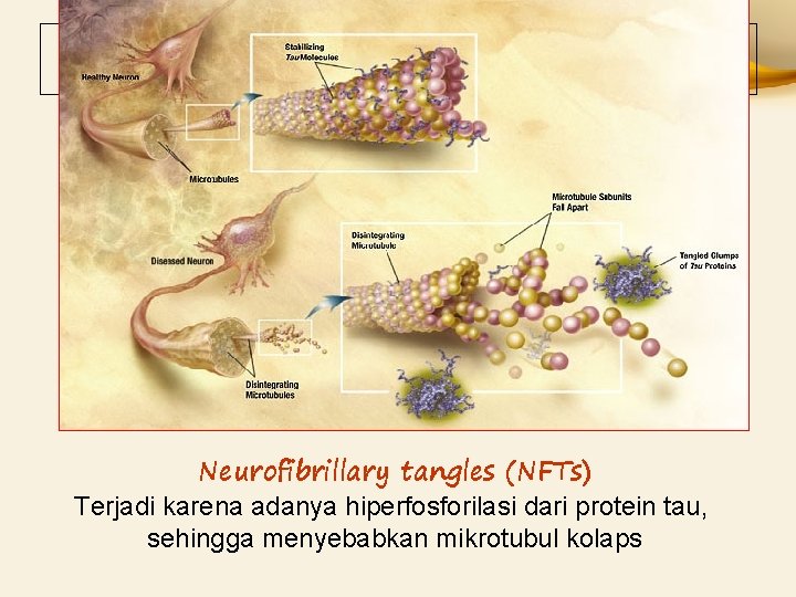 Neurofibrillary tangles (NFTs) Terjadi karena adanya hiperfosforilasi dari protein tau, sehingga menyebabkan mikrotubul kolaps