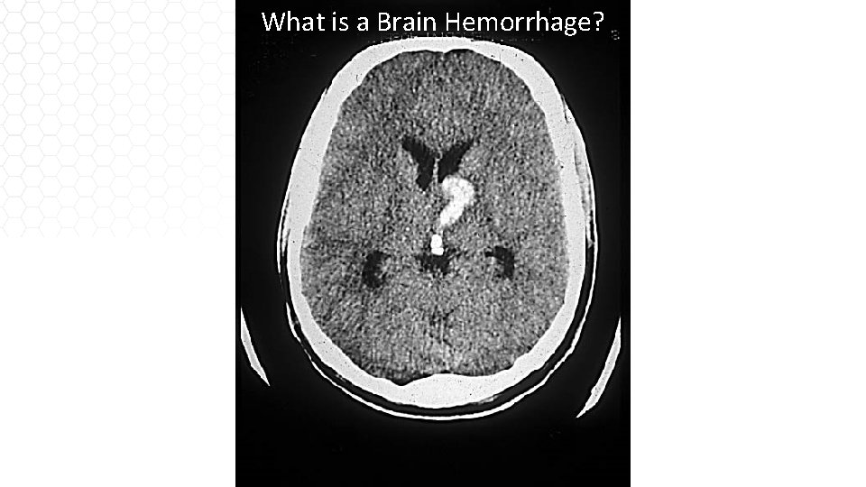 What is a Brain Hemorrhage? 