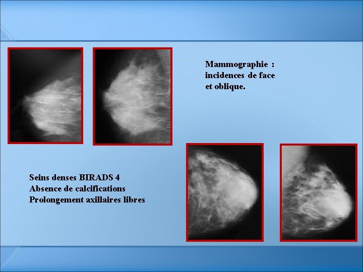 Mammographie : incidences de face et oblique. Seins denses BIRADS 4 Absence de calcifications