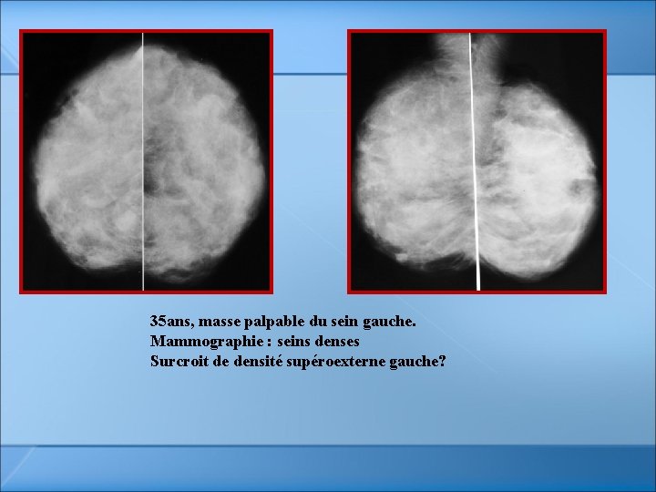 35 ans, masse palpable du sein gauche. Mammographie : seins denses Surcroit de densité