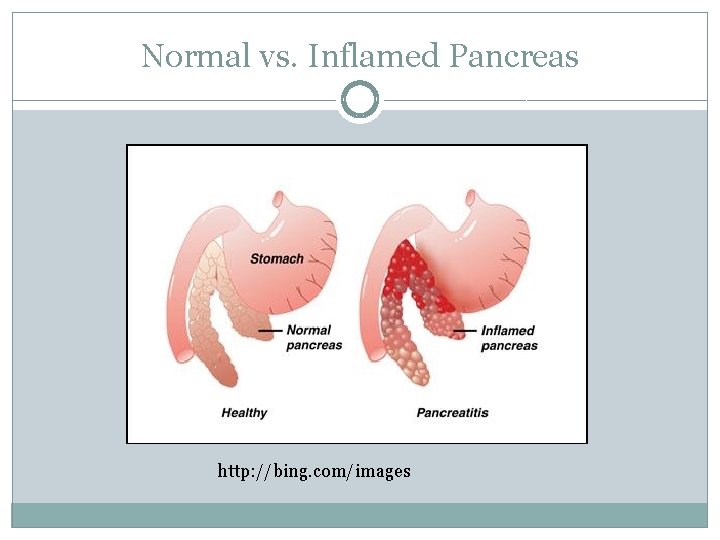 Normal vs. Inflamed Pancreas http: //bing. com/images 