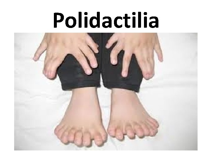 Polidactilia 