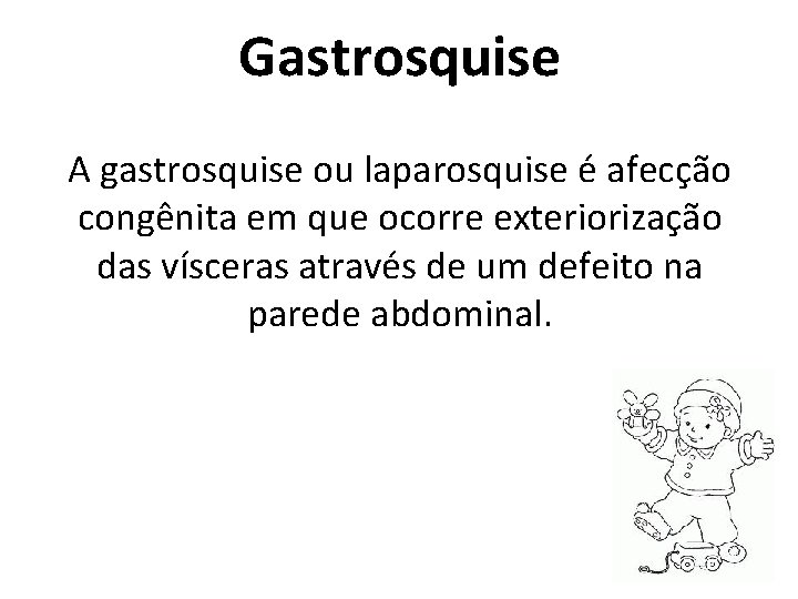 Gastrosquise A gastrosquise ou laparosquise é afecção congênita em que ocorre exteriorização das vísceras