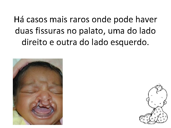 Há casos mais raros onde pode haver duas fissuras no palato, uma do lado