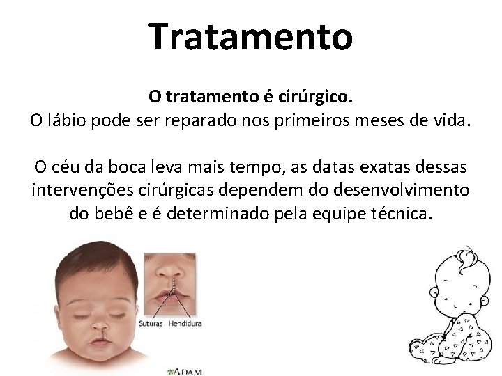 Tratamento O tratamento é cirúrgico. O lábio pode ser reparado nos primeiros meses de