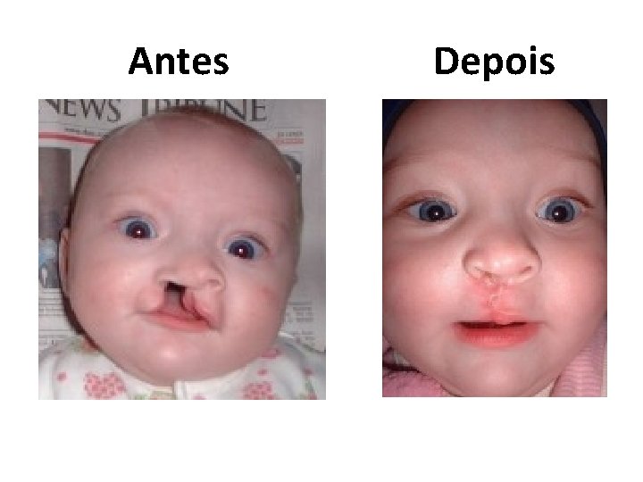  Antes Depois 