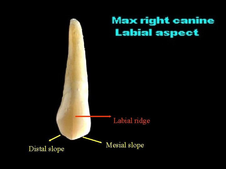 Labial ridge Distal slope Mesial slope 