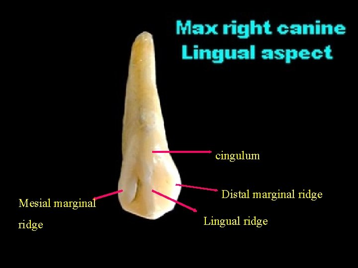 cingulum Mesial marginal ridge Distal marginal ridge Lingual ridge 