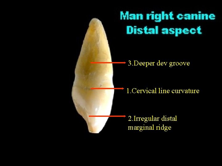 3. Deeper dev groove 1. Cervical line curvature 2. Irregular distal marginal ridge 