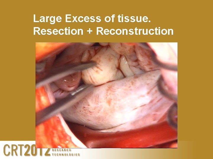 Large Excess of tissue. Resection + Reconstruction 