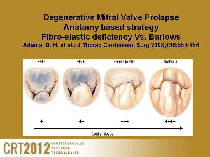 Degenerative Mitral Valve Prolapse Anatomy based strategy Fibro-elastic deficiency Vs. Barlows Adams D. H.