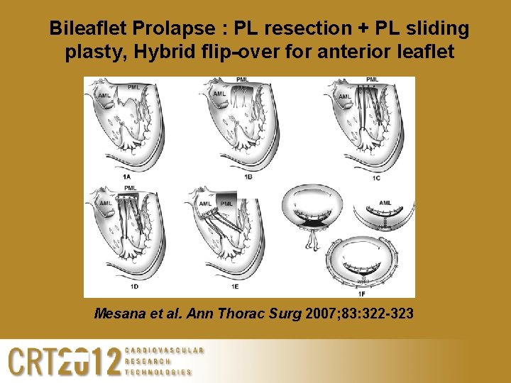 Bileaflet Prolapse : PL resection + PL sliding plasty, Hybrid flip-over for anterior leaflet
