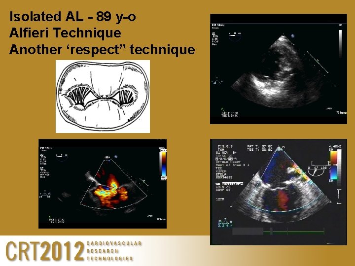 Isolated AL - 89 y-o Alfieri Technique Another ‘respect” technique 