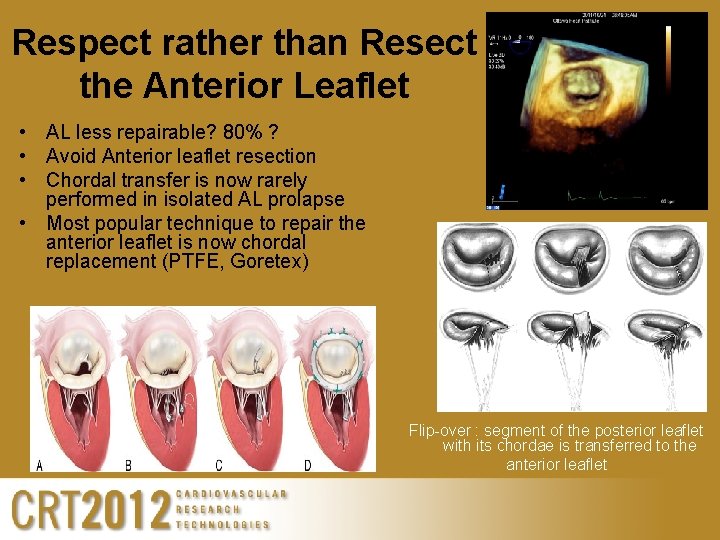 Respect rather than Resect the Anterior Leaflet • AL less repairable? 80% ? •